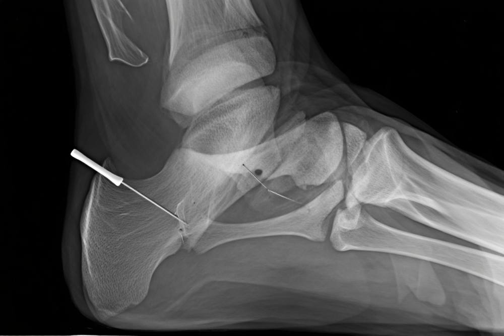 presentation-d-une-cheville-avec-broches-apres-chirurgie-pour-fracture-de-la-malleole Présentation d'une cheville avec broches après chirurgie pour fracture de la malléole
