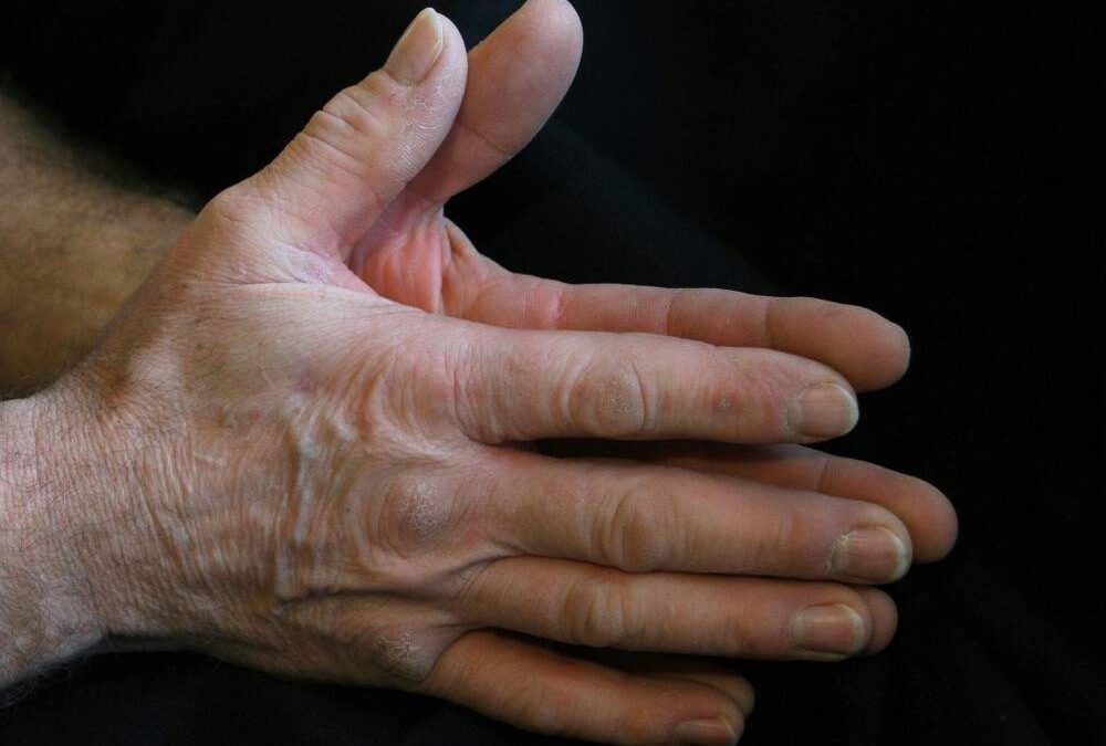 Algodystrophie : Symptômes, causes et traitements