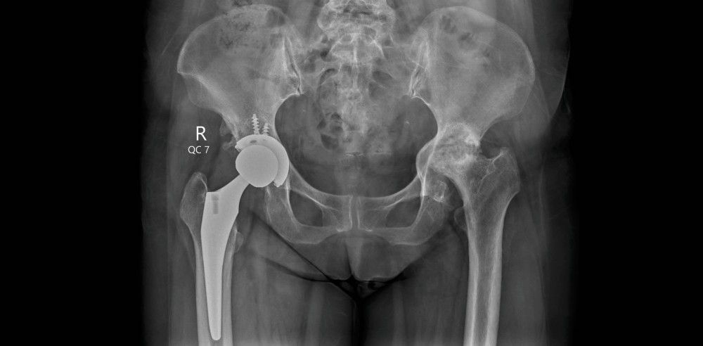 Combien de temps pour marcher normalement après prothèse de hanche​ ?