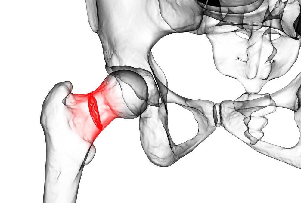 Fracture du col du fémur photo