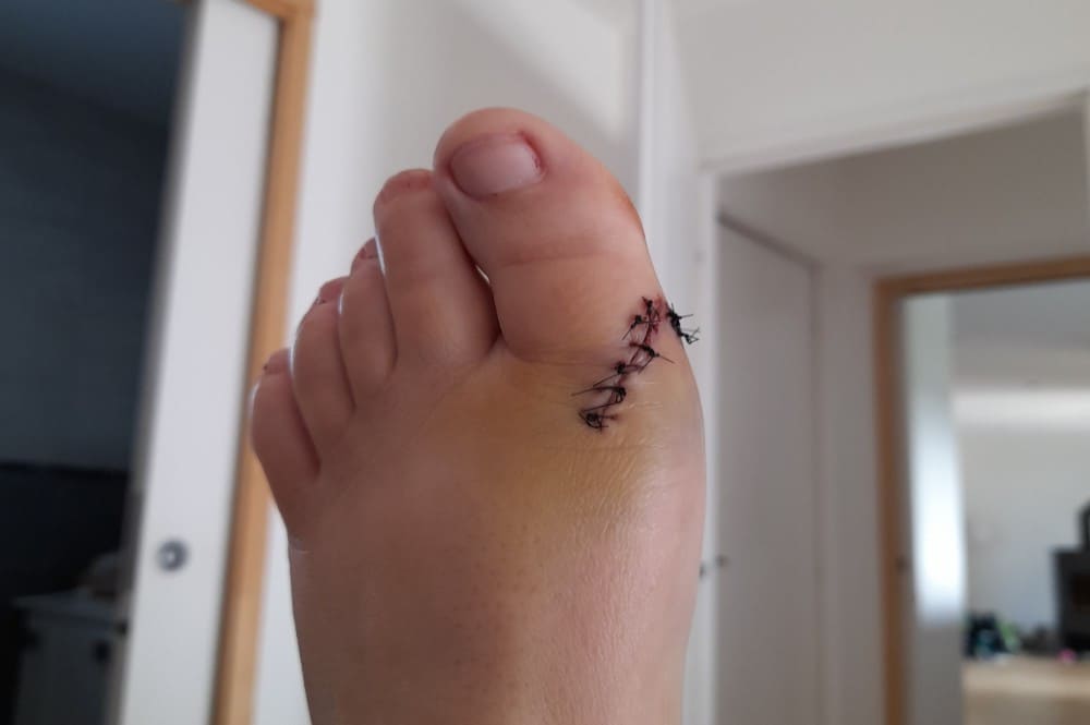 Blessure pied gauche fil résorbable combien de temps
