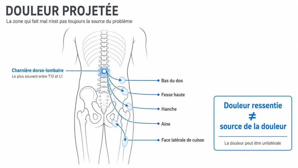 DOULEUR PROJETÉE. La zone qui fait mal n’est pas toujours la source du problème.