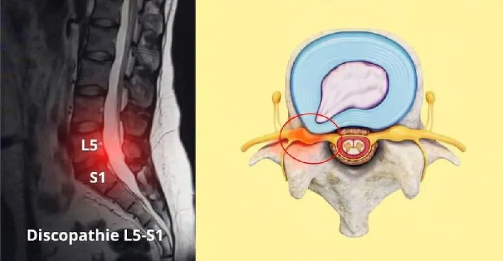 Montage montrant une IRM lombaire L5-S1 et un schéma de vertèbre avec irritation nerveuse.